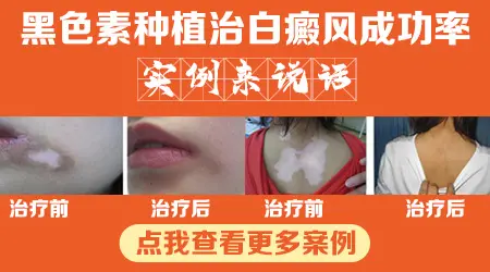 脸上白癜风做种植手术后的效果图