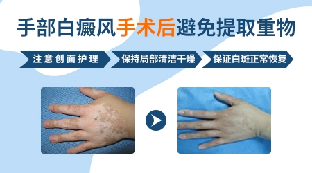 手上白癜风做种植手术效果怎么样