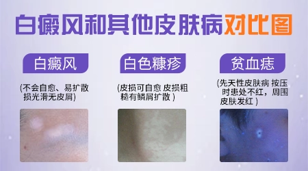白斑和白癜风误诊案例对比图