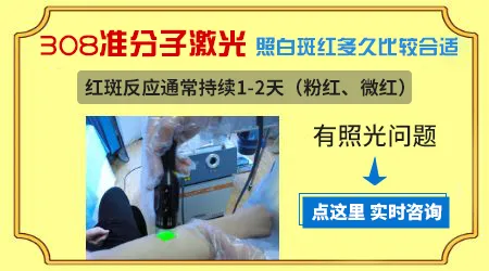 白癜风照光剂量多少合适 照到发红才好吗