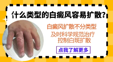 晕痣型白癜风会扩散吗