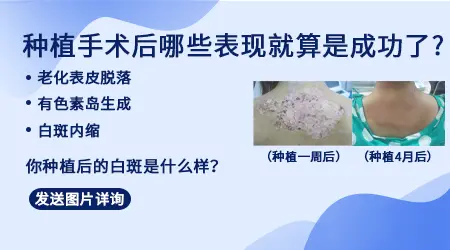 白斑做移植手术治疗是怎么收费的