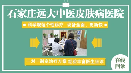 精神性白癜风能治好吗