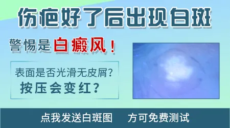 烫伤留下的白斑和白癜风白斑区别