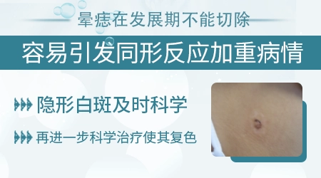 晕痣白癜风必须手术切除吗