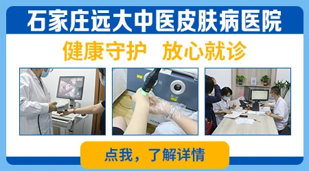 石家庄专治皮肤白斑
