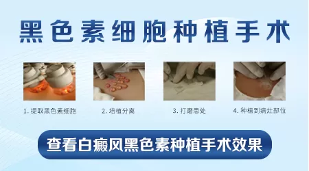 什么类型的白癜风适合做种植