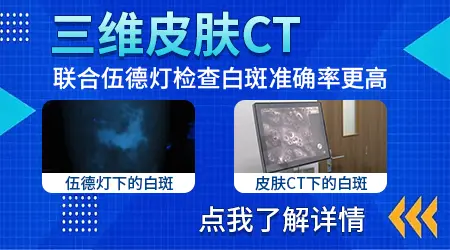 自己如何判断白斑是不是白癜风图片