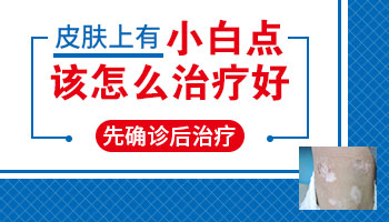 光滑的白斑会不会是白癜风 能治疗吗