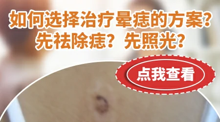 晕痣光疗一般需要做多少次
