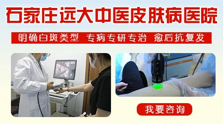 石家庄白癜风医院哪家专业