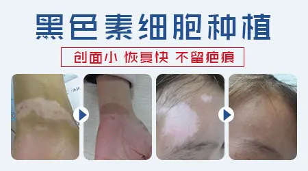 白癜风自体表皮移植术后会留疤吗