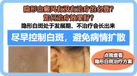 有新增隐藏白斑用不用治疗
