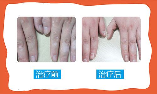 石家庄能治好白癜风吗 石家庄远大白癜风评价