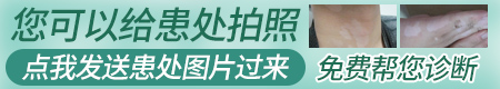 正常白斑图片 儿童白癜风白斑有什么特征