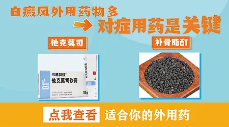 局限型小面积白斑用什么外用药效果好