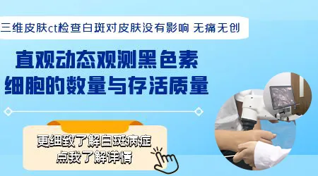 皮肤ct检测白斑对治疗有什么作用