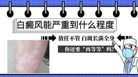 身上白块检查黑色素脱失病情严重吗