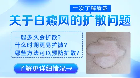 幼儿白癜风好治疗年龄是几岁开始