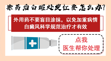 疫情期间白癜风患者能在家使用外用药治疗吗