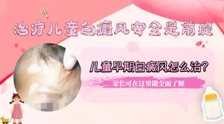 专治儿童身上白癜风的方法