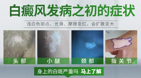 白癜风早期是什么症状图片