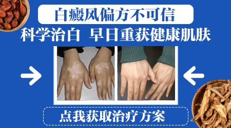 无花果叶到底能不能治白癜风