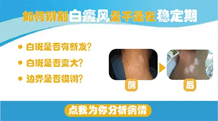 白癜风停止扩散多久才算稳定期