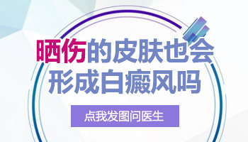 皮肤晒伤局部变白了是白癜风吗