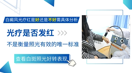 白癜风光疗后发红是有效果吗