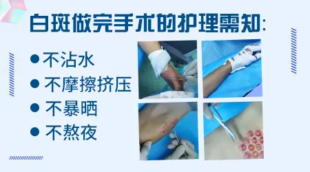 白癜风手术费用大概多少钱 医保能报销吗