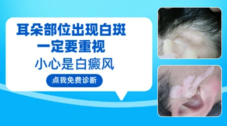 耳朵长白斑初期的症状图片