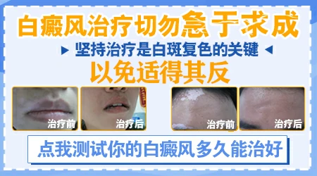 白癜风做311紫外线光疗效果怎么样