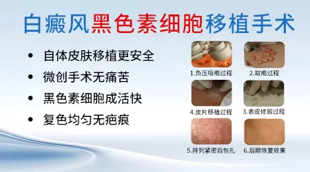黑色素移植手术白斑多久消失