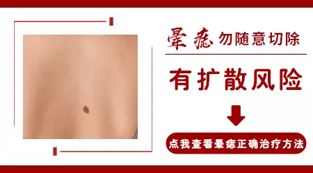 晕痣型白癜风会慢慢恢复吗