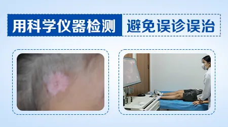 白癜风光疗后白斑边缘模糊是好转迹象吗
