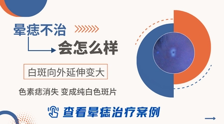 晕痣会变成泛发型白癜风吗