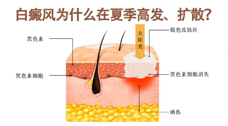 北京白癜风专家公益联诊-石家庄远大中医皮肤病医院