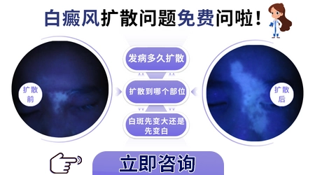儿童白癜风会扩散到全身吗