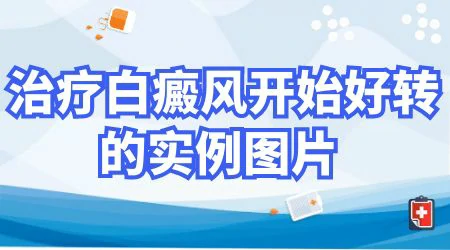 白癜风发红是好转吗 如何判断白癜风是否好转