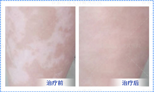 大腿根内侧起白斑怎么回事