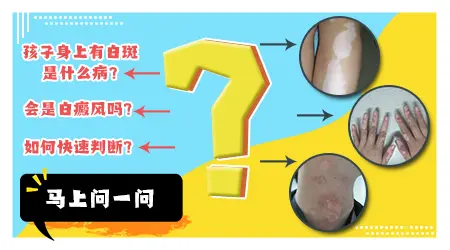 2岁宝宝大腿根右侧发白是白癜风吗