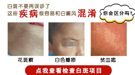 白癜风初期是什么样的图片