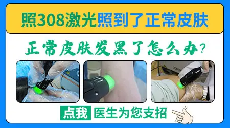 白癜风光疗后正常皮肤变黑了能恢复吗