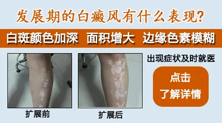 点状的小白斑慢慢变大是白癜风的进展吗