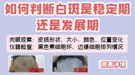 白斑稳定期和进展期如何判断