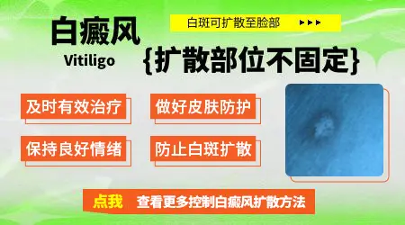 什么类型的白癜风容易扩散
