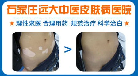 石家庄有白癜风专科医院吗