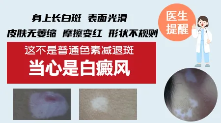 脖子上的白斑摩擦后发红是白癜风吗