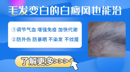 白癜风处毛发变白是不是代表病情严重